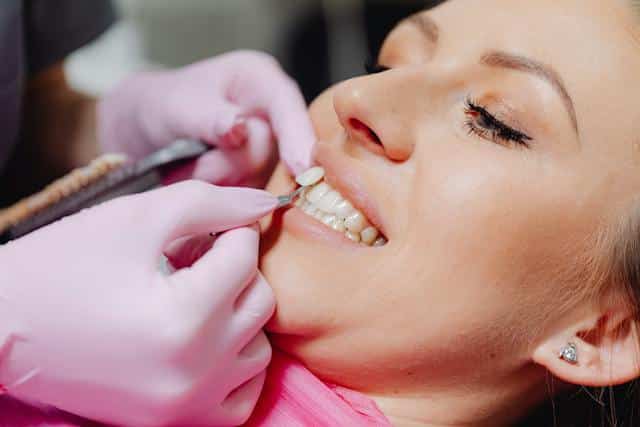 Veneers: When Should You Get Them