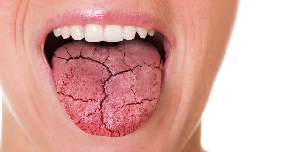Dry Mouth Demystified: Causes, Symptoms, and Solutions